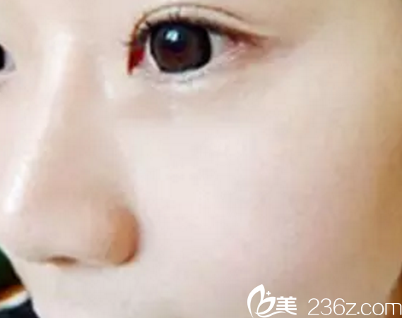  术后20天从无盐女变女神，分享我在济源萍做激光祛斑术手术效果