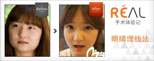 韩国丽儿整形医院双眼皮手术案例 韩国丽儿整形医院双眼皮手术案例