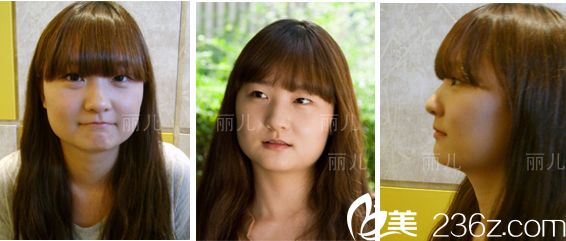 金寿信下颌角手术案例 金寿信下颌角手术案例