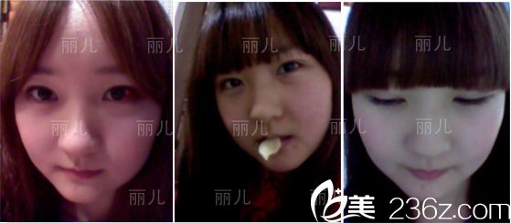 术后三周后效果 术后三周后效果