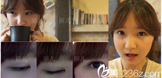 下颌角手术一个月后效果 下颌角手术一个月后效果