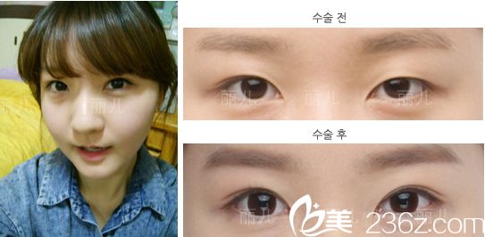 等了一个月终于预约上了金寿信，随后在韩国丽儿整形医院做了双眼皮+颧骨内推+下颌角手术后我重新拾起了自信