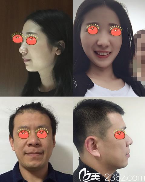 杭州维多利亚柳兆峰做激光除皱案例