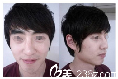 术前歪鼻子鹰钩鼻 术前歪鼻子鹰钩鼻