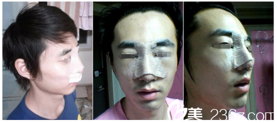 刚做完硅胶隆鼻手术 刚做完硅胶隆鼻手术