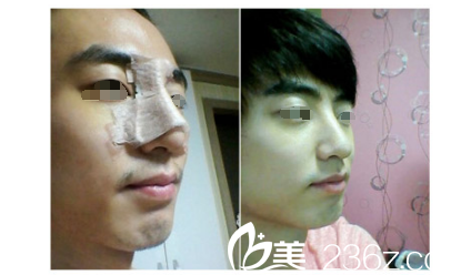 硅胶假体隆鼻术后恢复 硅胶假体隆鼻术后恢复