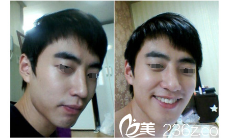 术后两周硅胶假体隆鼻恢复 术后两周硅胶假体隆鼻恢复