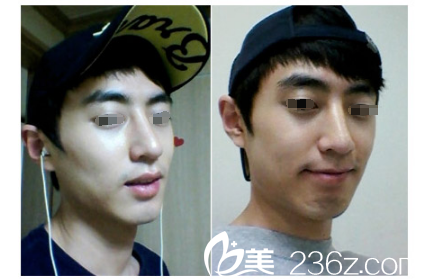 假体隆鼻术后一个月恢复 假体隆鼻术后一个月恢复