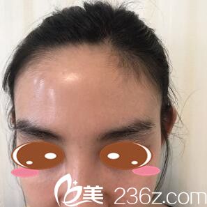 发际线种植术前照 发际线种植术前照