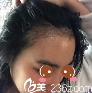 种植发际线半个月 种植发际线半个月