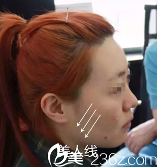 我在<!--<i data=20240703-sp></i>-->做6D面部线雕提升手术中照片 我在<!--<i data=20240703-sp></i>-->做6D面部线雕提升手术中照片