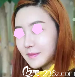 来看看我在整形做6D面部线雕提升一周后的照片，对比效果明显吗？