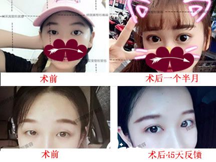 属于亳州缔美整形六针美瞳综合美眼术案例反馈