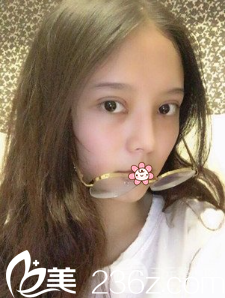 王志军全切双眼皮术后4天