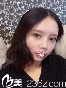 重庆联合丽格整形全切双眼皮术后半个月