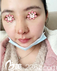 重庆曹阳丽格鼻综合术后三天 重庆曹阳丽格鼻综合术后三天