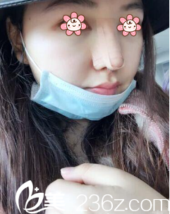 曹阳院长给我做完术后五天 曹阳院长给我做完术后五天