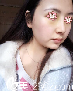 曹阳鼻综合+假体隆鼻术后8天 曹阳鼻综合+假体隆鼻术后8天