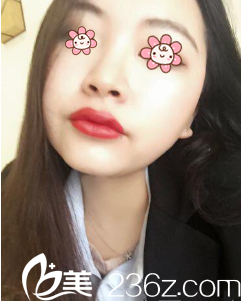 重庆曹阳丽格鼻综合+假体隆鼻术后19天效果 重庆曹阳丽格鼻综合+假体隆鼻术后19天效果