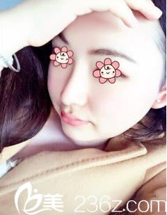 我叫王暻，是去年11月在重庆曹阳丽格院长那儿做的鼻综合+假体隆鼻手术。