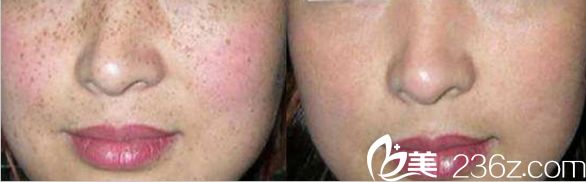 沈阳美莱整形医院激光祛斑对比图 沈阳美莱整形医院激光祛斑对比图