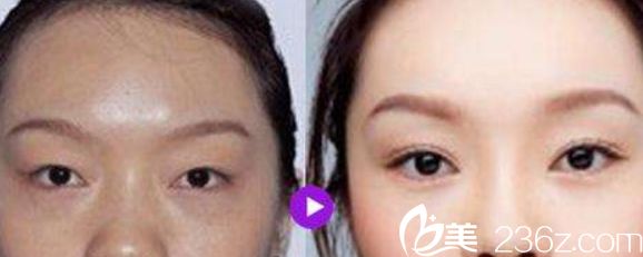 沈阳美莱美容医院双眼皮<span style= 沈阳美莱美容医院双眼皮<span style=