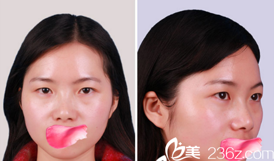 在烟台鹏爱整形医院同时做了全切双眼皮+鼻综合 在烟台鹏爱整形医院同时做了全切双眼皮+鼻综合