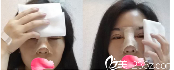 术后天我的样子 术后天我的样子