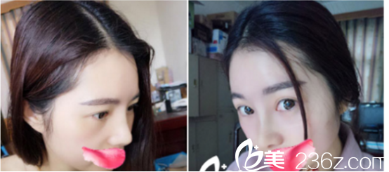 术后第20天基本已经不肿了 术后第20天基本已经不肿了