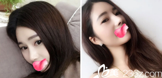 在烟台鹏爱整形医院同时做了全切双眼皮+鼻综合，也就是上上个月，到现在有两个月了，做的是肋软骨是会比较贵一点