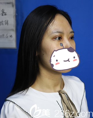 重睑术内眼角手术 重睑术内眼角手术