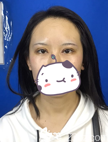 呼和浩特京美开眼角十天 呼和浩特京美开眼角十天