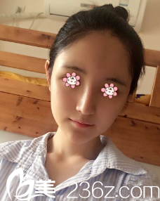 何山自体脂肪填充额头术后十天 何山自体脂肪填充额头术后十天