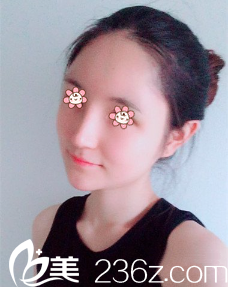 新疆伊丽莎白整形自体脂肪填充额头垫下巴术后18天 新疆伊丽莎白整形自体脂肪填充额头垫下巴术后18天