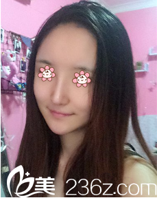 何山鼻综合术后27天 何山鼻综合术后27天