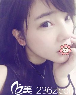 冯辉利双眼皮加假体隆鼻术后18天 冯辉利双眼皮加假体隆鼻术后18天