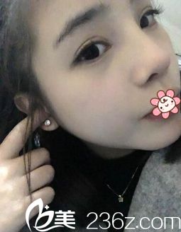 冯辉利假体隆鼻一个月恢复效果 冯辉利假体隆鼻一个月恢复效果