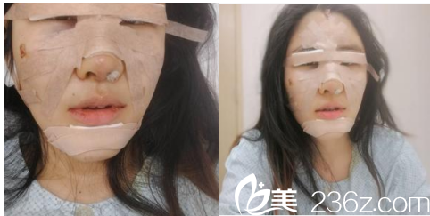 在北京叶美人找余森林脂肪填充鼻综合双眼皮第2天