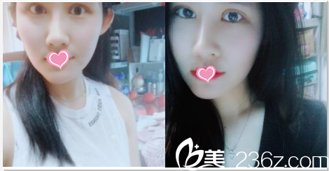北京叶美人做隆鼻双眼皮自体脂肪面部填充第31天样子