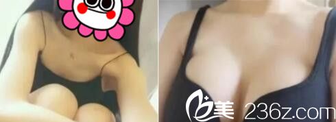 上海九院曹卫刚自体脂肪隆胸真人案例术前术后对比