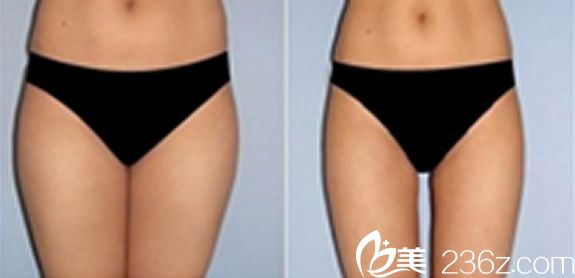 韩国本沐整形全身抽脂效果图 韩国本沐整形全身抽脂效果图