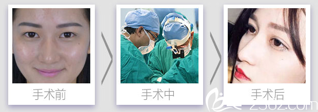 <!--<i data=20240703-sp></i>-->医生全切双眼皮手术案例 <!--<i data=20240703-sp></i>-->医生全切双眼皮手术案例