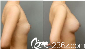 韩国Pureart整形外科医院脂肪丰胸案例 韩国Pureart整形外科医院脂肪丰胸案例