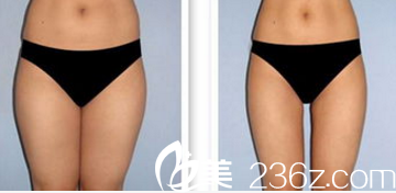 韩国Pureart整形外科医院腿部吸脂案例 韩国Pureart整形外科医院腿部吸脂案例