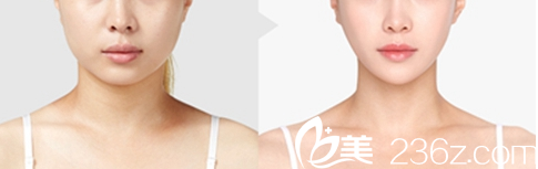 韩国Pureart整形外科医院面部轮廓案例 韩国Pureart整形外科医院面部轮廓案例