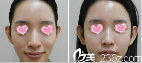 韩国Pureart整形外科医院面部脂肪填充案例 韩国Pureart整形外科医院面部脂肪填充案例