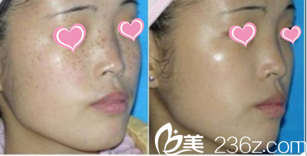 韩国Pureart整形外科医院皮肤美容案例 韩国Pureart整形外科医院皮肤美容案例