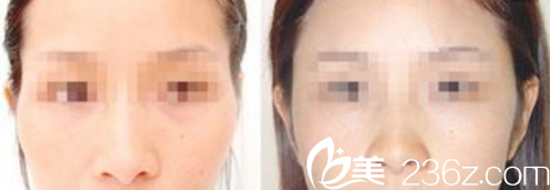 韩国Pureart整形外科自体脂肪丰太阳穴案例 韩国Pureart整形外科自体脂肪丰太阳穴案例