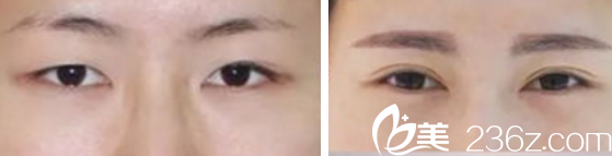韩国Pureart整形外科双眼皮案例 韩国Pureart整形外科双眼皮案例