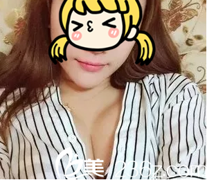 任万洙脂肪丰胸案例第47天样子 任万洙脂肪丰胸案例第47天样子